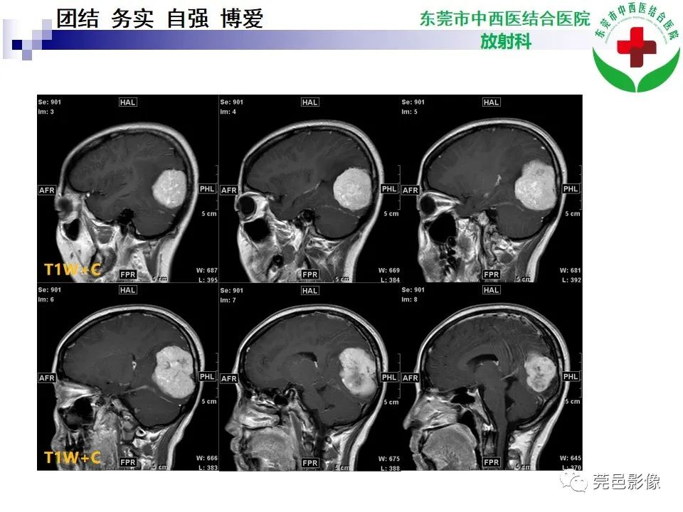 影像PPT - 【PPT】颅内孤立性纤维性肿瘤的影像诊断-9