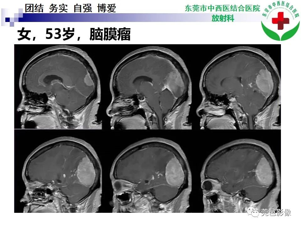 影像PPT - 【PPT】颅内孤立性纤维性肿瘤的影像诊断-21
