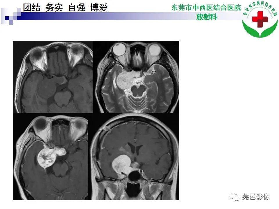 影像PPT - 【PPT】颅内孤立性纤维性肿瘤的影像诊断-23