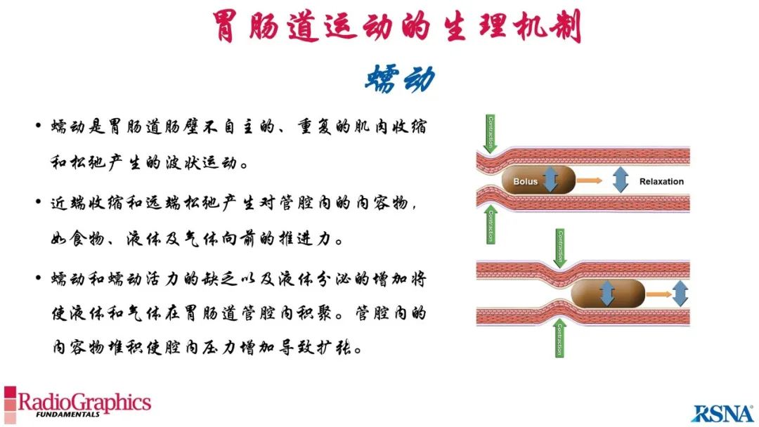 影像PPT - 【PPT】胃肠道扩张:为什么会发生以及如何发生的病理生理机制？——简易的影像学分类-17