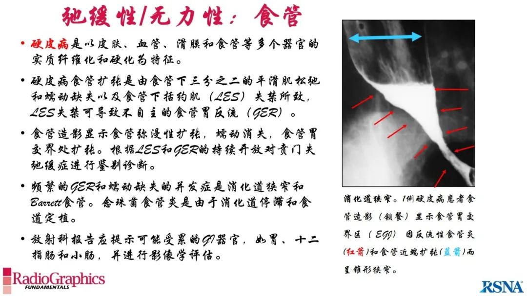 影像PPT - 【PPT】胃肠道扩张:为什么会发生以及如何发生的病理生理机制？——简易的影像学分类-23