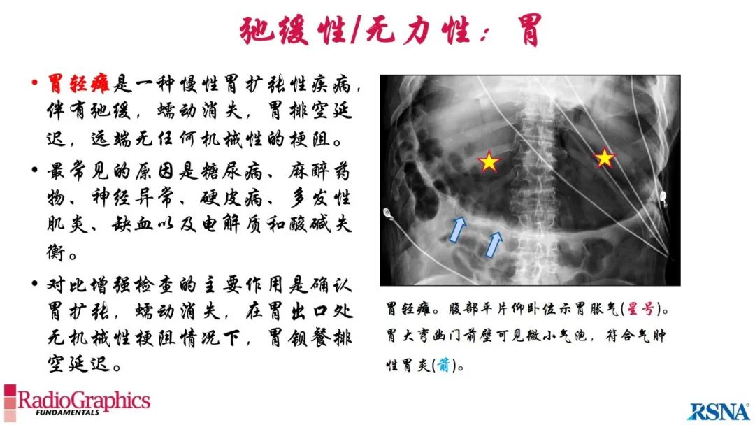 影像PPT - 【PPT】胃肠道扩张:为什么会发生以及如何发生的病理生理机制？——简易的影像学分类-25