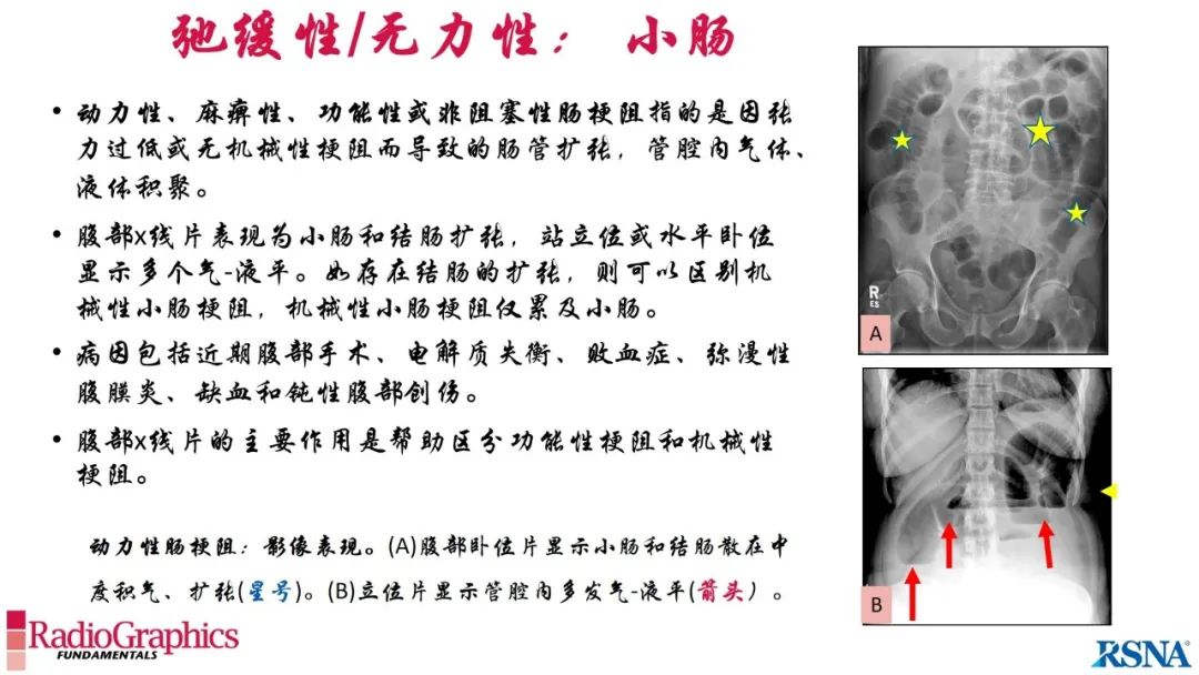 影像PPT - 【PPT】胃肠道扩张:为什么会发生以及如何发生的病理生理机制？——简易的影像学分类-27