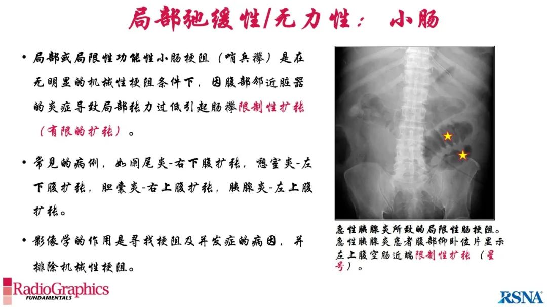 影像PPT - 【PPT】胃肠道扩张:为什么会发生以及如何发生的病理生理机制？——简易的影像学分类-29