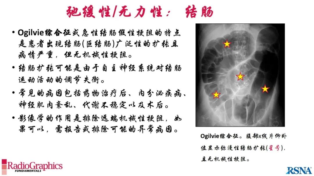 影像PPT - 【PPT】胃肠道扩张:为什么会发生以及如何发生的病理生理机制？——简易的影像学分类-31