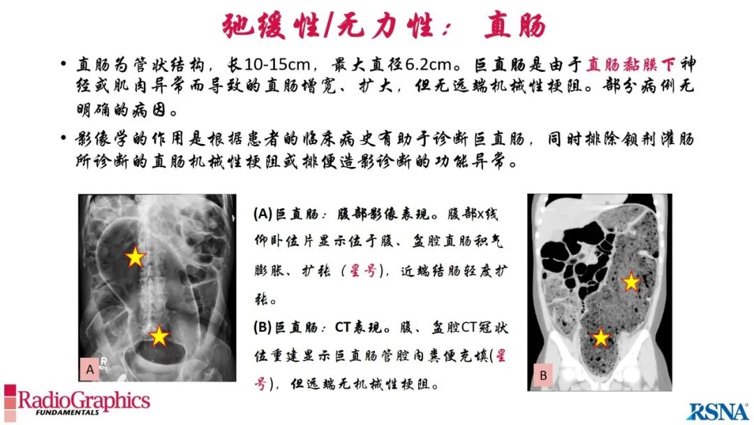 影像PPT - 【PPT】胃肠道扩张:为什么会发生以及如何发生的病理生理机制？——简易的影像学分类-33