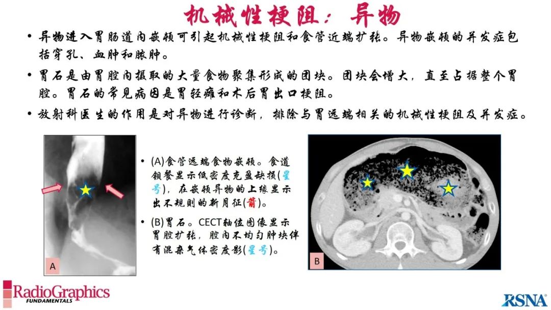 影像PPT - 【PPT】胃肠道扩张:为什么会发生以及如何发生的病理生理机制？——简易的影像学分类-39
