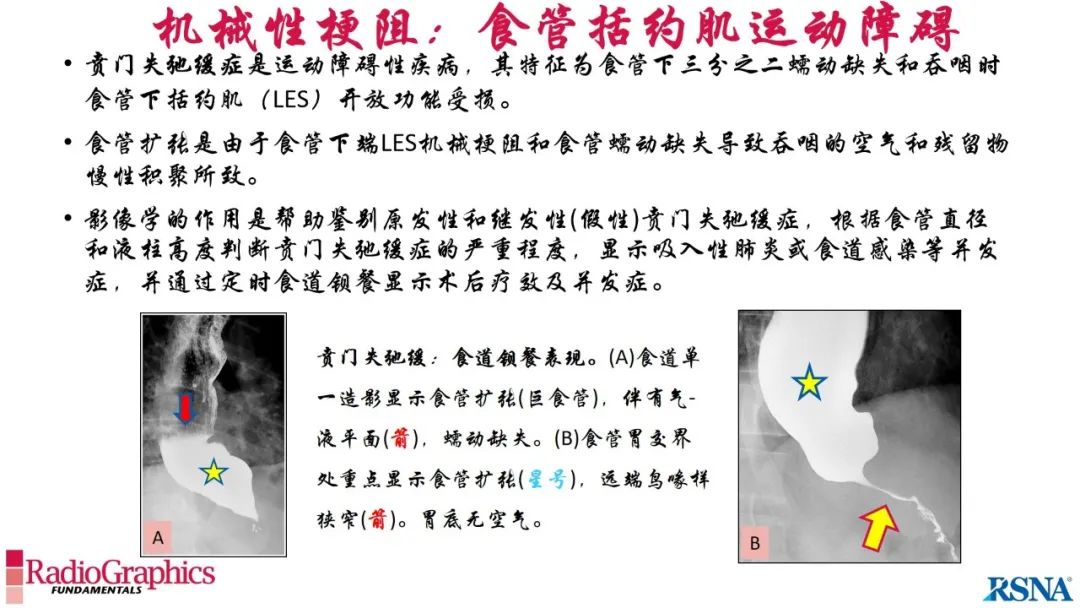 影像PPT - 【PPT】胃肠道扩张:为什么会发生以及如何发生的病理生理机制？——简易的影像学分类-41