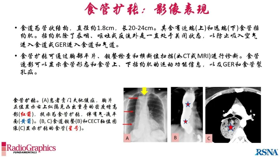 影像PPT - 【PPT】胃肠道扩张:为什么会发生以及如何发生的病理生理机制？——简易的影像学分类-37