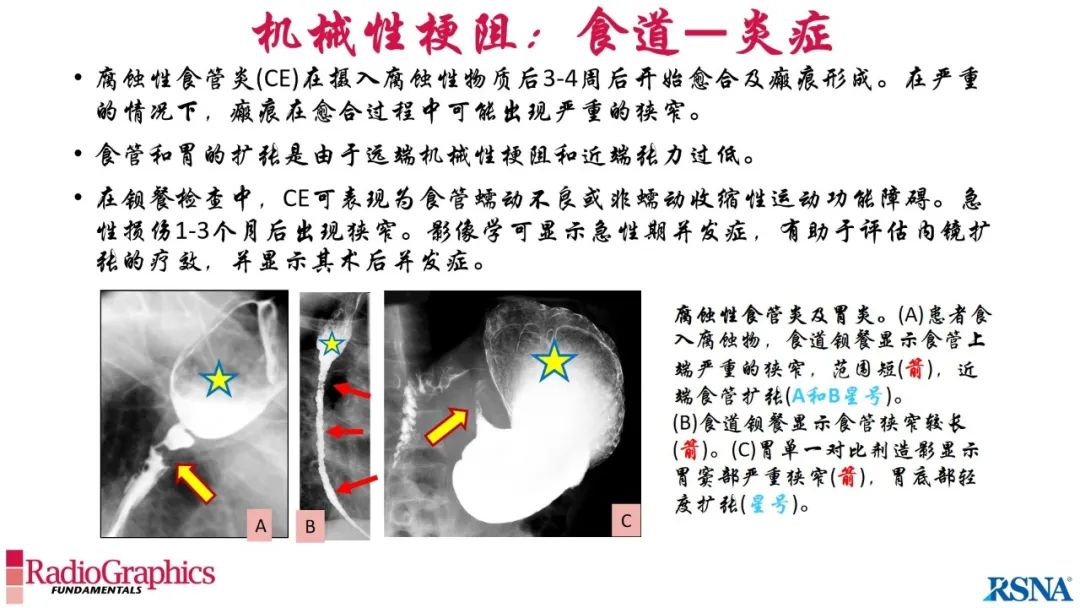 影像PPT - 【PPT】胃肠道扩张:为什么会发生以及如何发生的病理生理机制？——简易的影像学分类-43