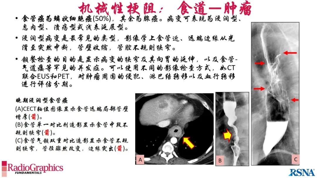 影像PPT - 【PPT】胃肠道扩张:为什么会发生以及如何发生的病理生理机制？——简易的影像学分类-45