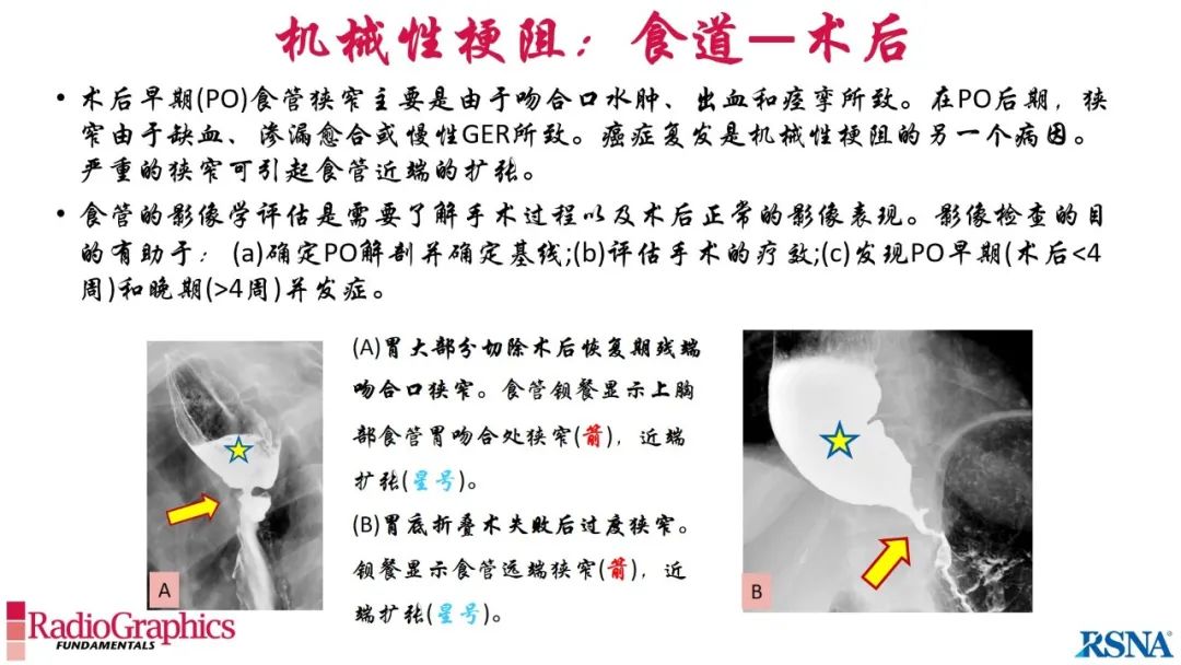 影像PPT - 【PPT】胃肠道扩张:为什么会发生以及如何发生的病理生理机制？——简易的影像学分类-47