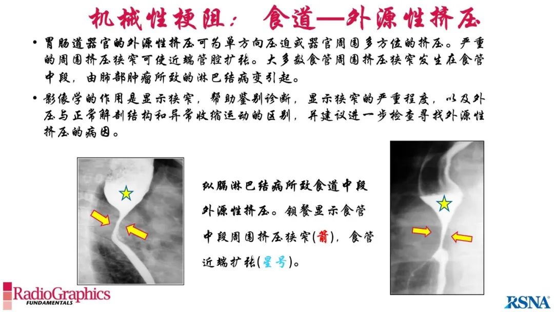影像PPT - 【PPT】胃肠道扩张:为什么会发生以及如何发生的病理生理机制？——简易的影像学分类-49