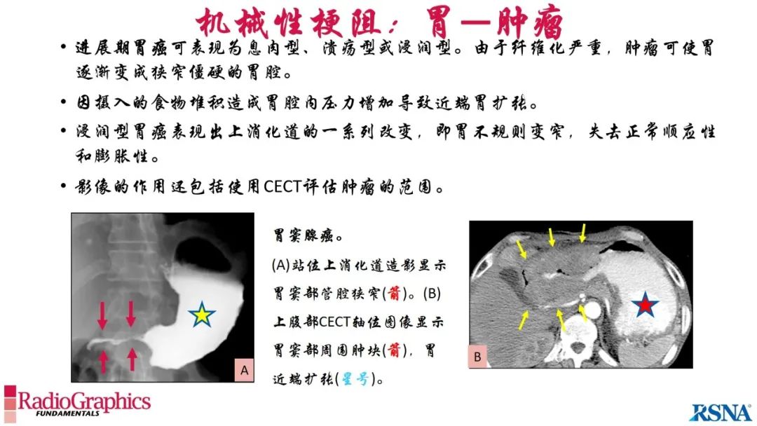 影像PPT - 【PPT】胃肠道扩张:为什么会发生以及如何发生的病理生理机制？——简易的影像学分类-51