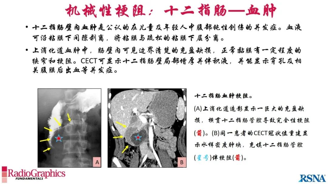 影像PPT - 【PPT】胃肠道扩张:为什么会发生以及如何发生的病理生理机制？——简易的影像学分类-53