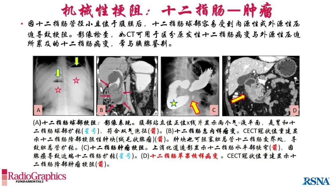 影像PPT - 【PPT】胃肠道扩张:为什么会发生以及如何发生的病理生理机制？——简易的影像学分类-57