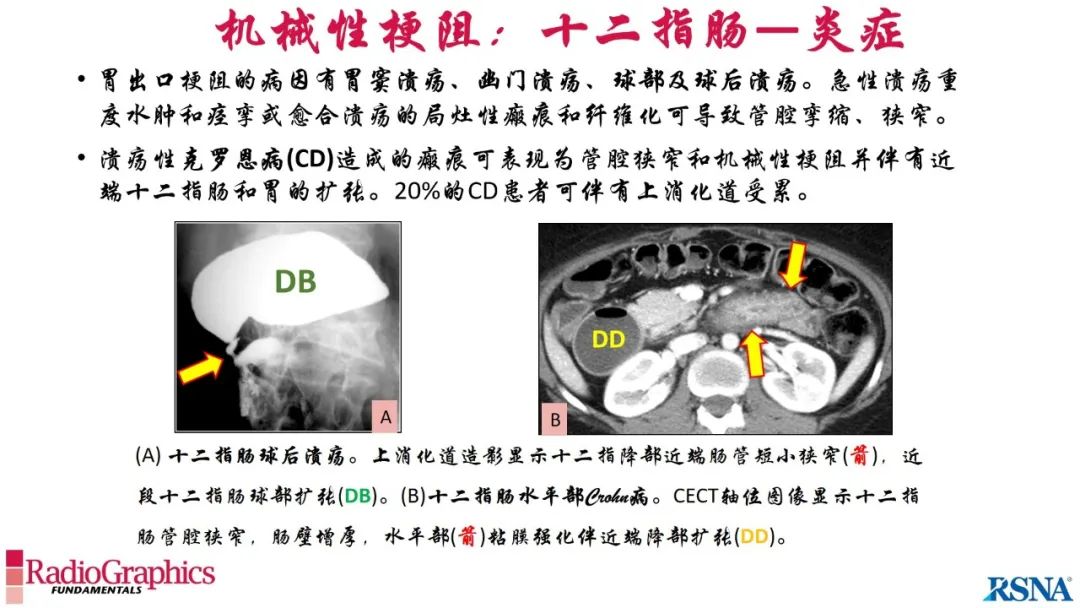 影像PPT - 【PPT】胃肠道扩张:为什么会发生以及如何发生的病理生理机制？——简易的影像学分类-55