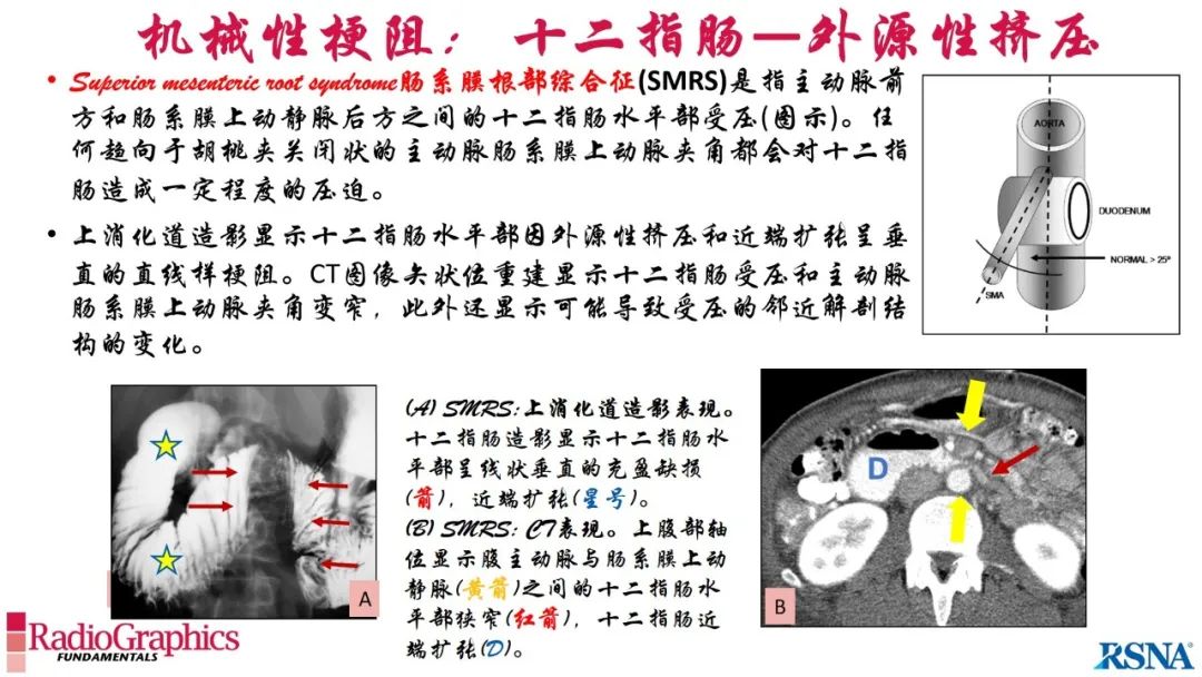 影像PPT - 【PPT】胃肠道扩张:为什么会发生以及如何发生的病理生理机制？——简易的影像学分类-59