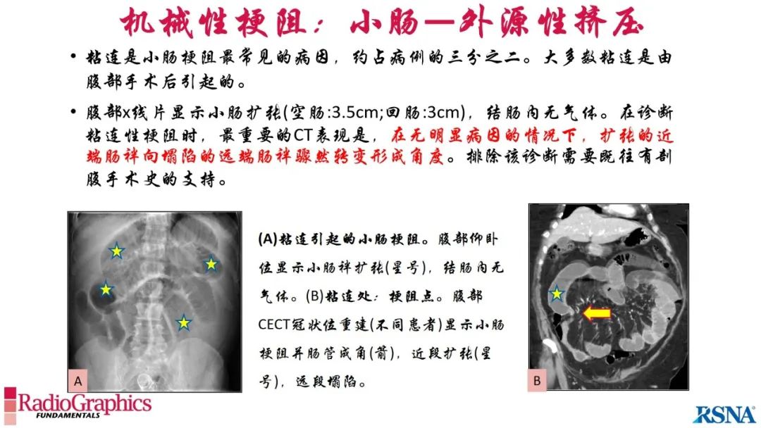 影像PPT - 【PPT】胃肠道扩张:为什么会发生以及如何发生的病理生理机制？——简易的影像学分类-61