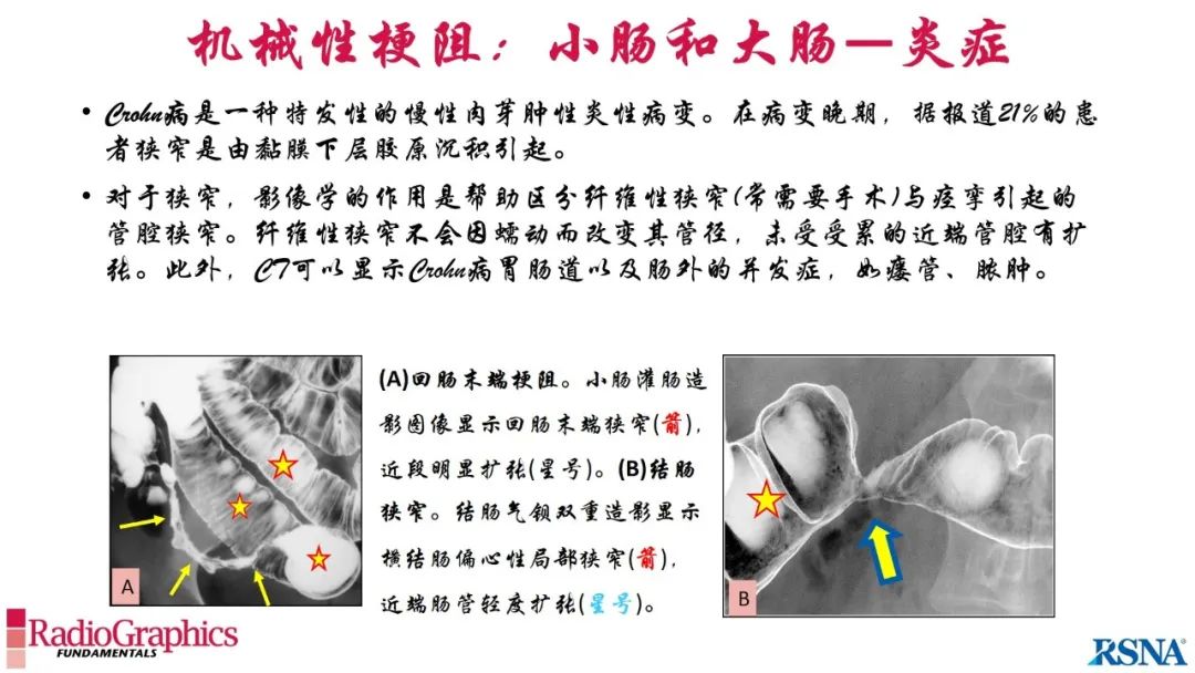 影像PPT - 【PPT】胃肠道扩张:为什么会发生以及如何发生的病理生理机制？——简易的影像学分类-65