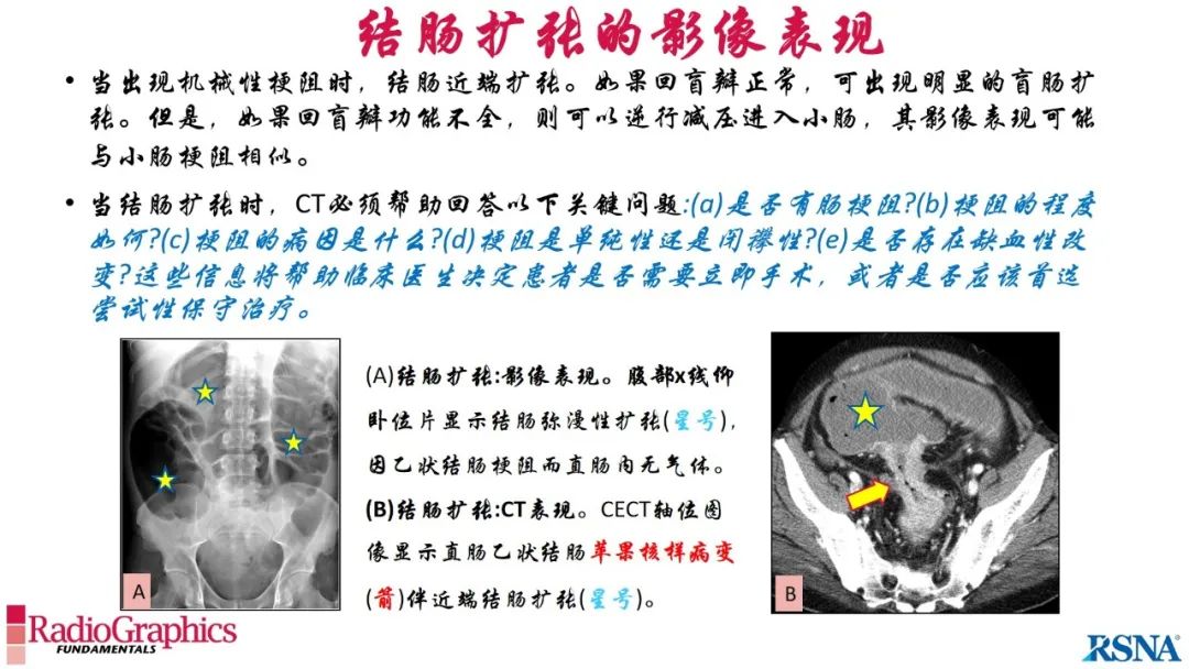 影像PPT - 【PPT】胃肠道扩张:为什么会发生以及如何发生的病理生理机制？——简易的影像学分类-67