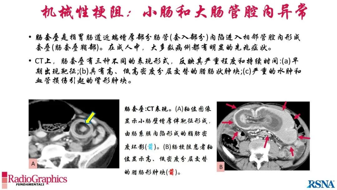 影像PPT - 【PPT】胃肠道扩张:为什么会发生以及如何发生的病理生理机制？——简易的影像学分类-63