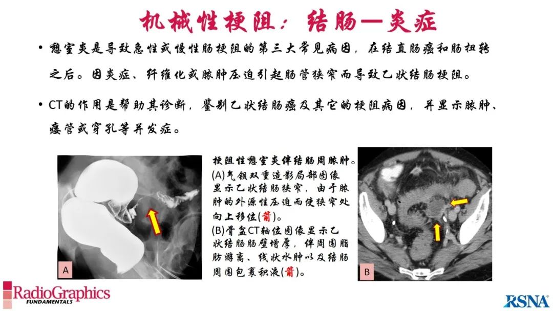 影像PPT - 【PPT】胃肠道扩张:为什么会发生以及如何发生的病理生理机制？——简易的影像学分类-69