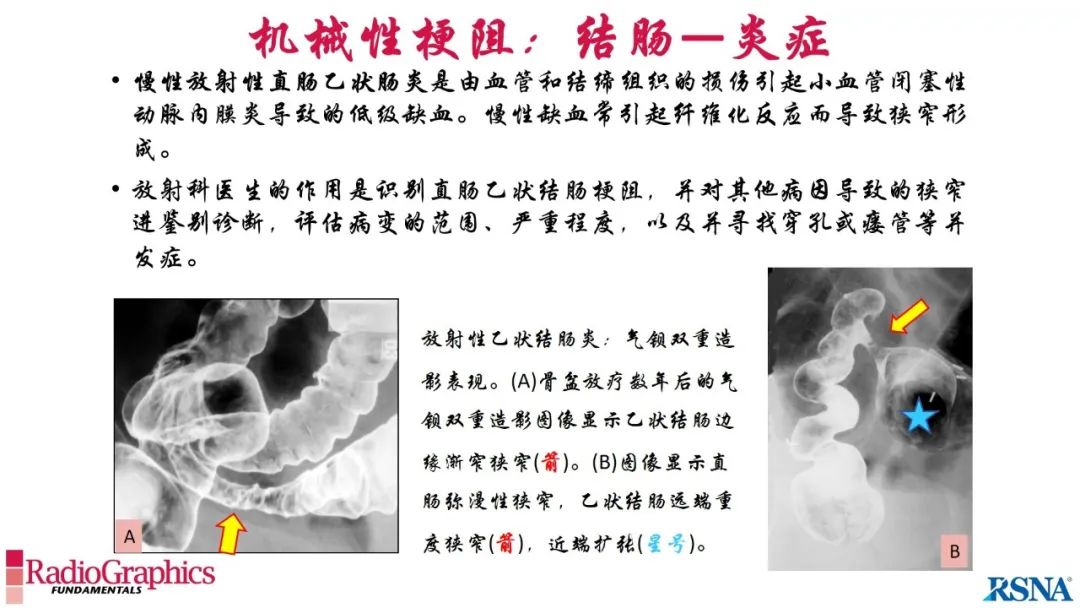 影像PPT - 【PPT】胃肠道扩张:为什么会发生以及如何发生的病理生理机制？——简易的影像学分类-71