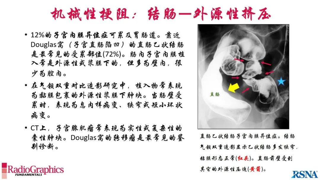 影像PPT - 【PPT】胃肠道扩张:为什么会发生以及如何发生的病理生理机制？——简易的影像学分类-73
