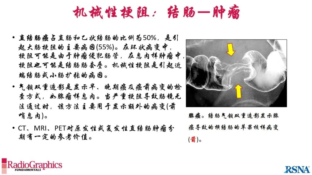 影像PPT - 【PPT】胃肠道扩张:为什么会发生以及如何发生的病理生理机制？——简易的影像学分类-75