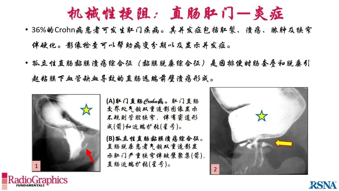 影像PPT - 【PPT】胃肠道扩张:为什么会发生以及如何发生的病理生理机制？——简易的影像学分类-77