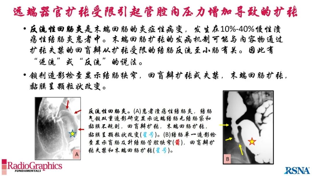 影像PPT - 【PPT】胃肠道扩张:为什么会发生以及如何发生的病理生理机制？——简易的影像学分类-81