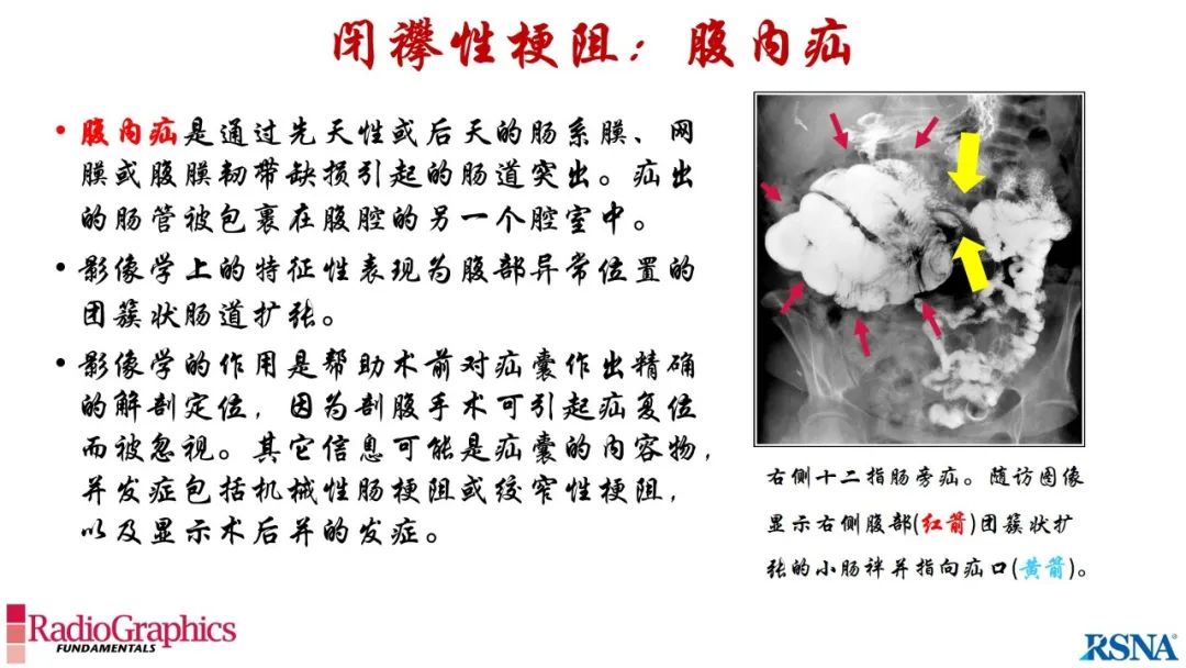 影像PPT - 【PPT】胃肠道扩张:为什么会发生以及如何发生的病理生理机制？——简易的影像学分类-85
