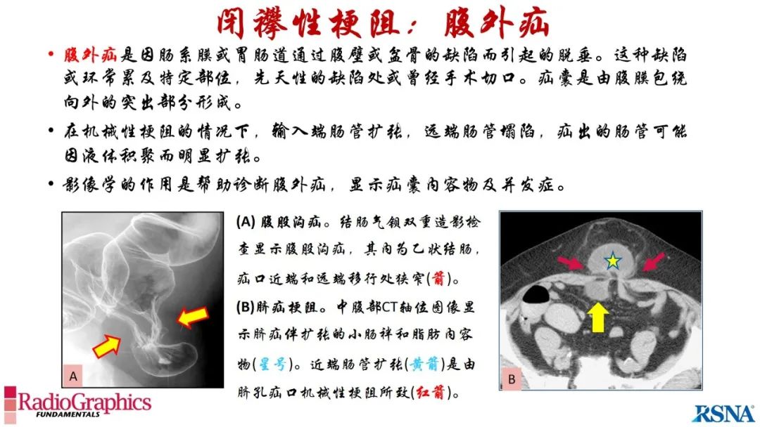 影像PPT - 【PPT】胃肠道扩张:为什么会发生以及如何发生的病理生理机制？——简易的影像学分类-87