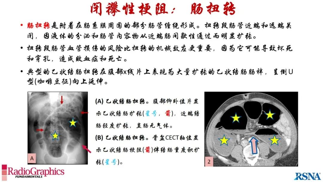 影像PPT - 【PPT】胃肠道扩张:为什么会发生以及如何发生的病理生理机制？——简易的影像学分类-89