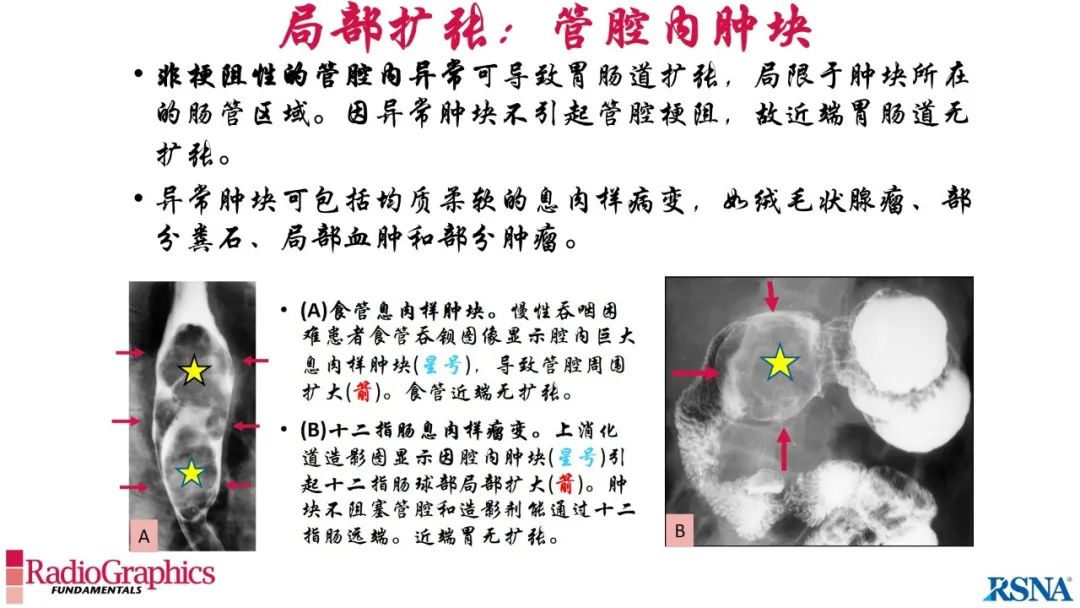 影像PPT - 【PPT】胃肠道扩张:为什么会发生以及如何发生的病理生理机制？——简易的影像学分类-93