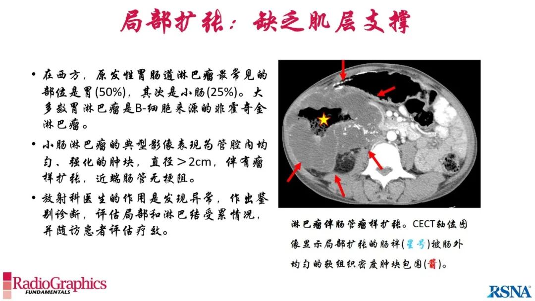 影像PPT - 【PPT】胃肠道扩张:为什么会发生以及如何发生的病理生理机制？——简易的影像学分类-95