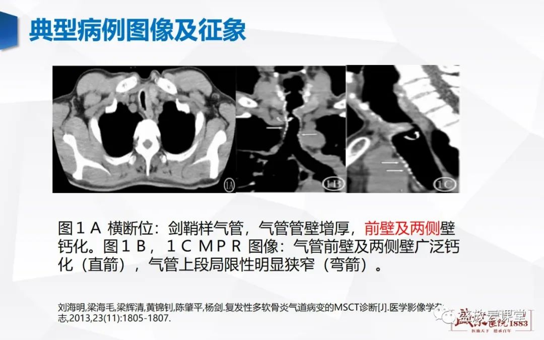 影像PPT - 【病例】复发性多软骨炎 及支气管异物各一例CT影像-4