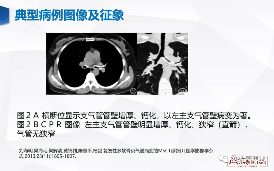 影像PPT - 【病例】复发性多软骨炎 及支气管异物各一例CT影像-5
