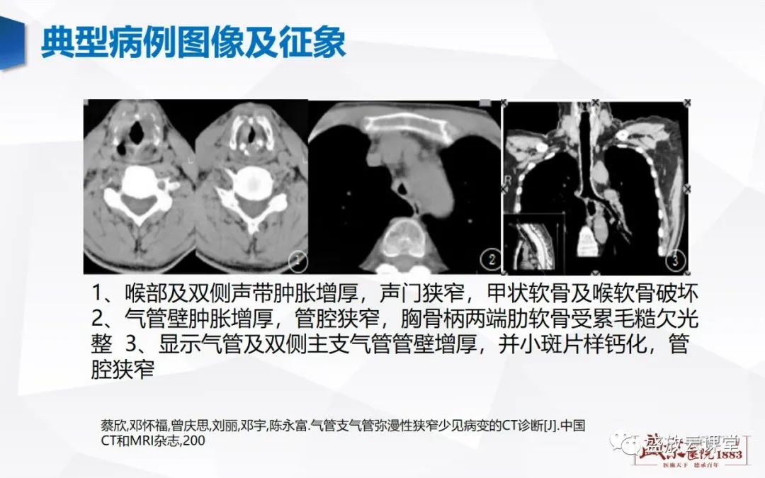 影像PPT - 【病例】复发性多软骨炎 及支气管异物各一例CT影像-6