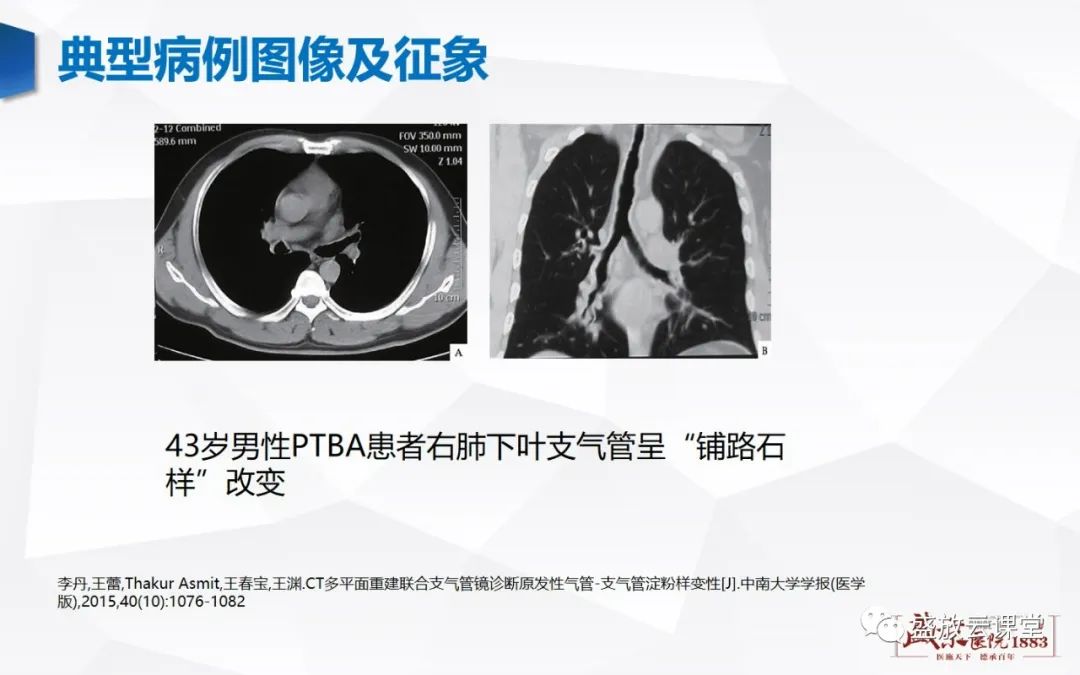 影像PPT - 【病例】复发性多软骨炎 及支气管异物各一例CT影像-11