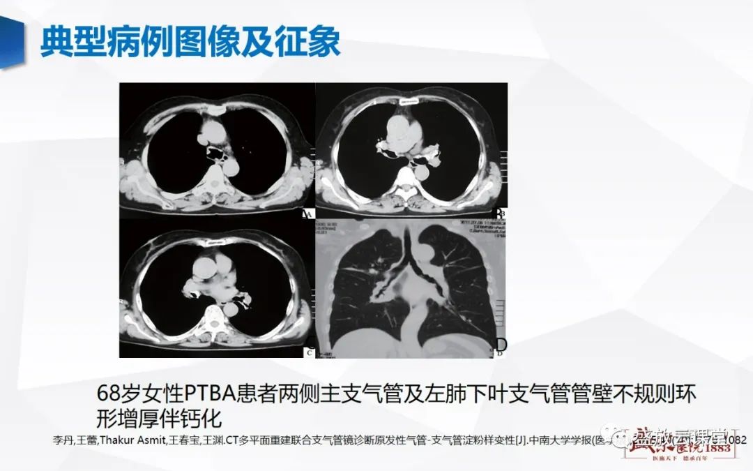 影像PPT - 【病例】复发性多软骨炎 及支气管异物各一例CT影像-12