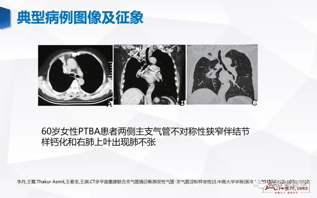 影像PPT - 【病例】复发性多软骨炎 及支气管异物各一例CT影像-13