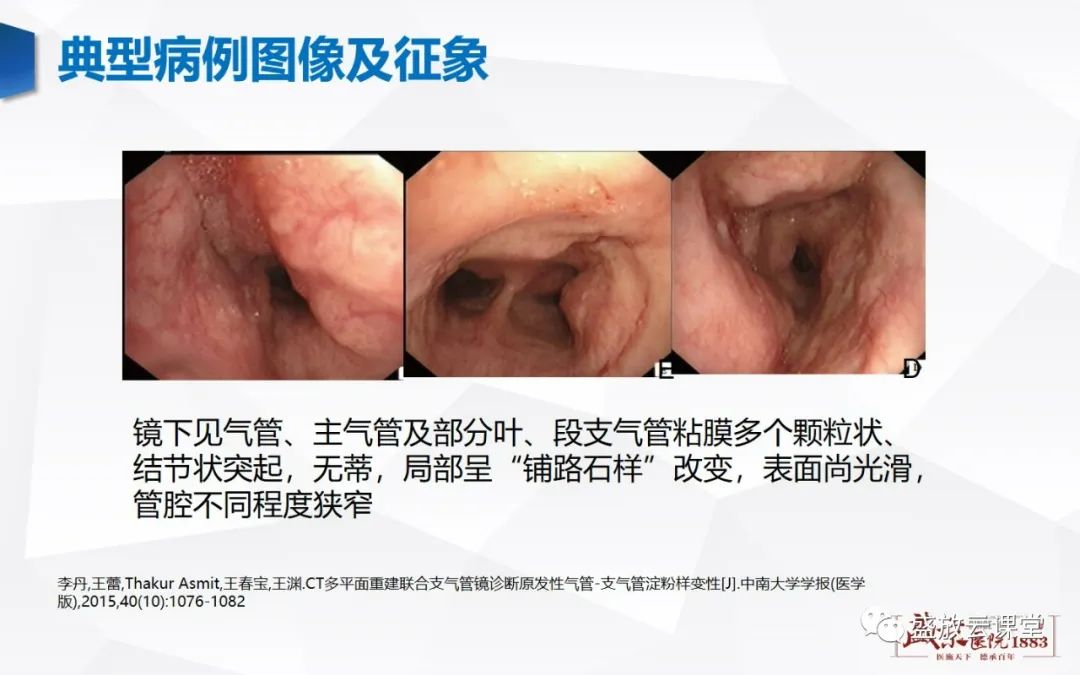 影像PPT - 【病例】复发性多软骨炎 及支气管异物各一例CT影像-14