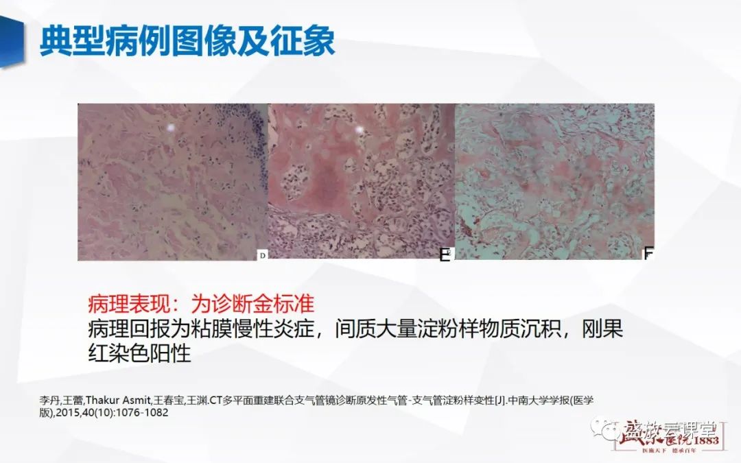影像PPT - 【病例】复发性多软骨炎 及支气管异物各一例CT影像-15