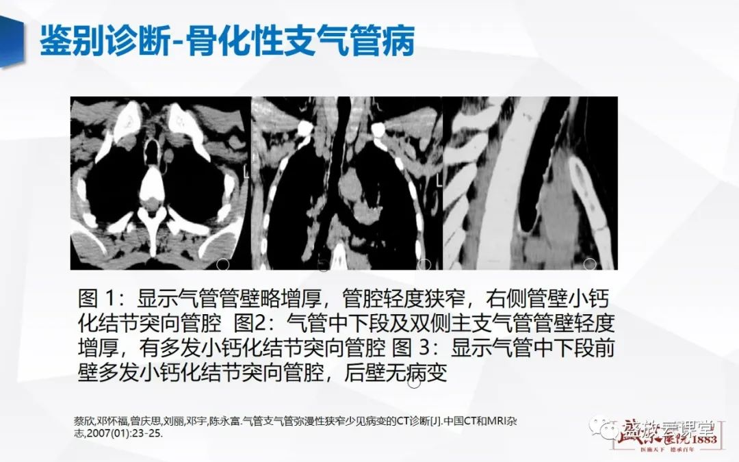 影像PPT - 【病例】复发性多软骨炎 及支气管异物各一例CT影像-17