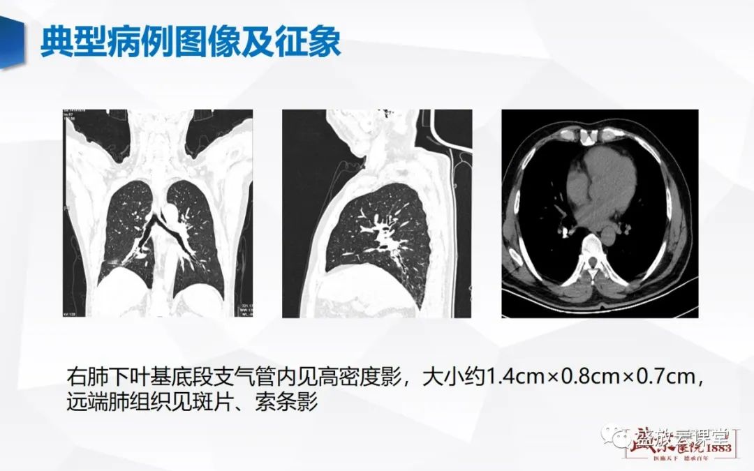 影像PPT - 【病例】复发性多软骨炎 及支气管异物各一例CT影像-21