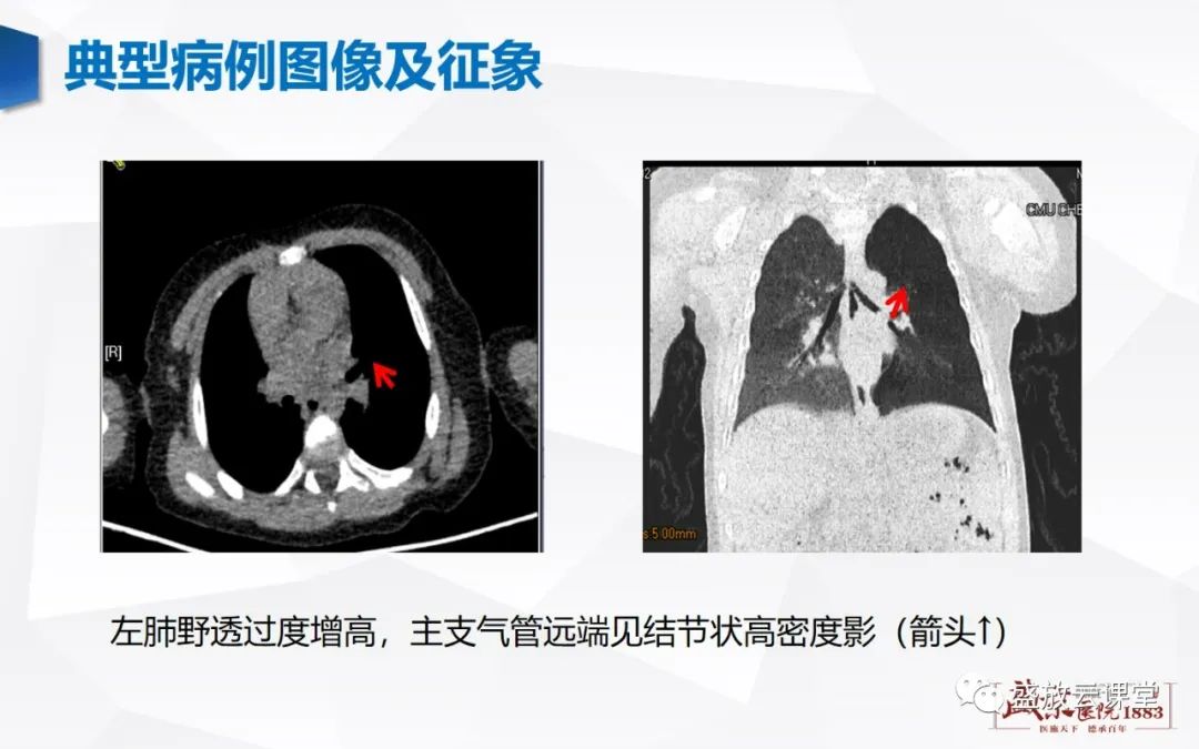 影像PPT - 【病例】复发性多软骨炎 及支气管异物各一例CT影像-24