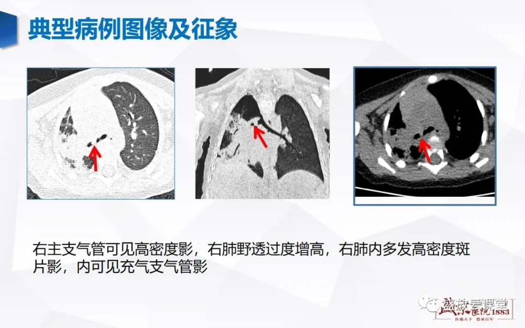 影像PPT - 【病例】复发性多软骨炎 及支气管异物各一例CT影像-27