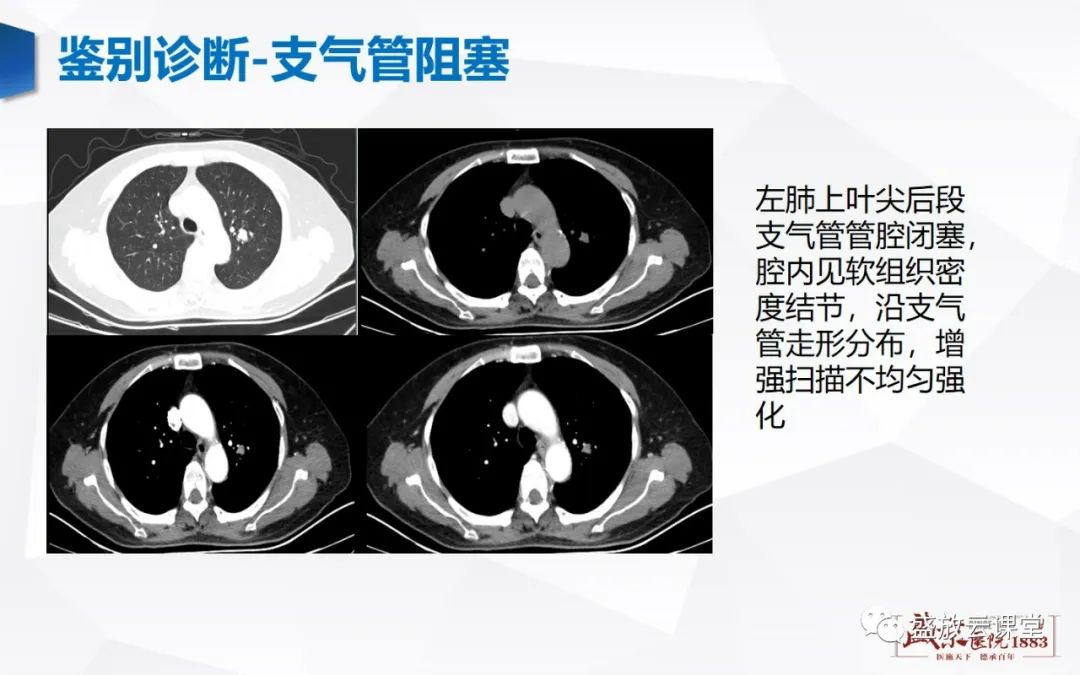 影像PPT - 【病例】复发性多软骨炎 及支气管异物各一例CT影像-1